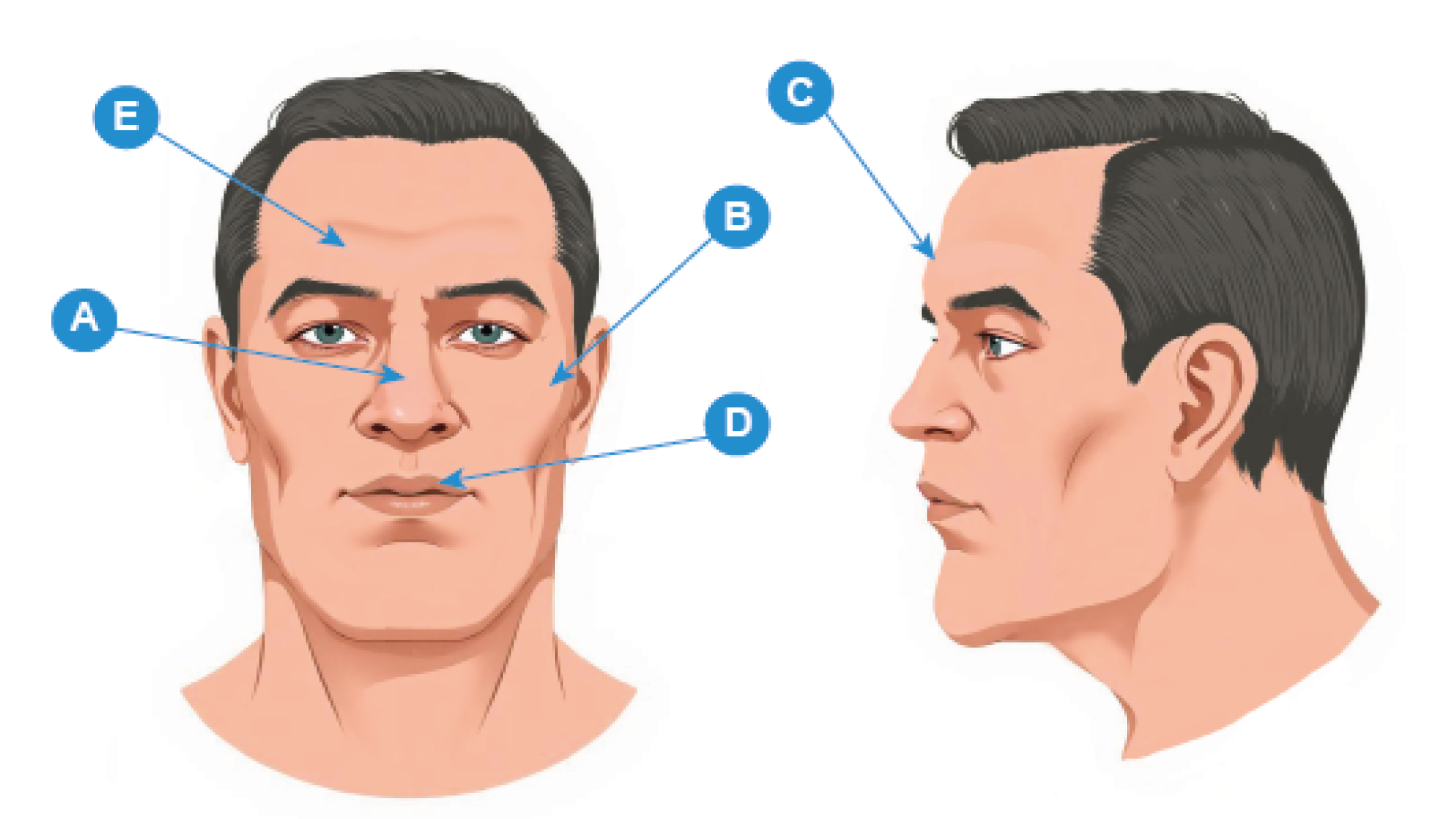 Figura 1: La nariz ensanchada, la frente abultada, los labios gruesos y las líneas faciales marcadas son señales típicas de acromegalia. Ilustración de la cara de un hombre con cinco puntos destacados mediante etiquetas de letras (A, B, C, D, E) que indican diferentes características faciales en la vista frontal y de perfil. La etiqueta A apunta a la nariz, B a la mejilla, C a la frente, D a los labios y E a la sien.