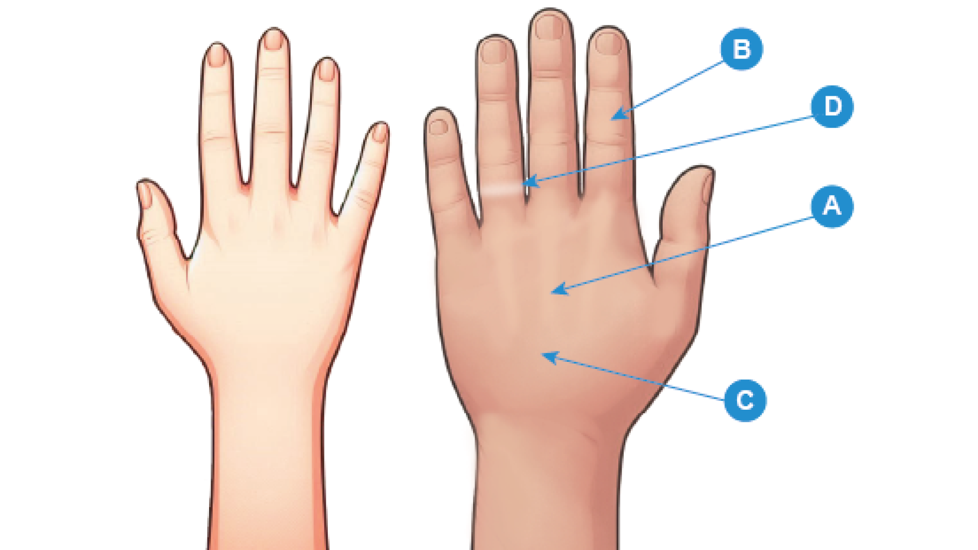 Figura 2: Se observa la mano de una persona normal (izquierda) y una de un paciente con acromegalia (derecha), agrandada y con los típicos dedos ensanchados. Ilustración de dos manos en vista dorsal, una clara y otra oscura, con etiquetas de letras (A, B, C, D, E) que indican diferentes partes de la mano en la mano derecha. La etiqueta A apunta al dorso de la mano, B al dedo índice, C a la parte baja de la mano, cerca de la muñeca, D a la base del dedo.