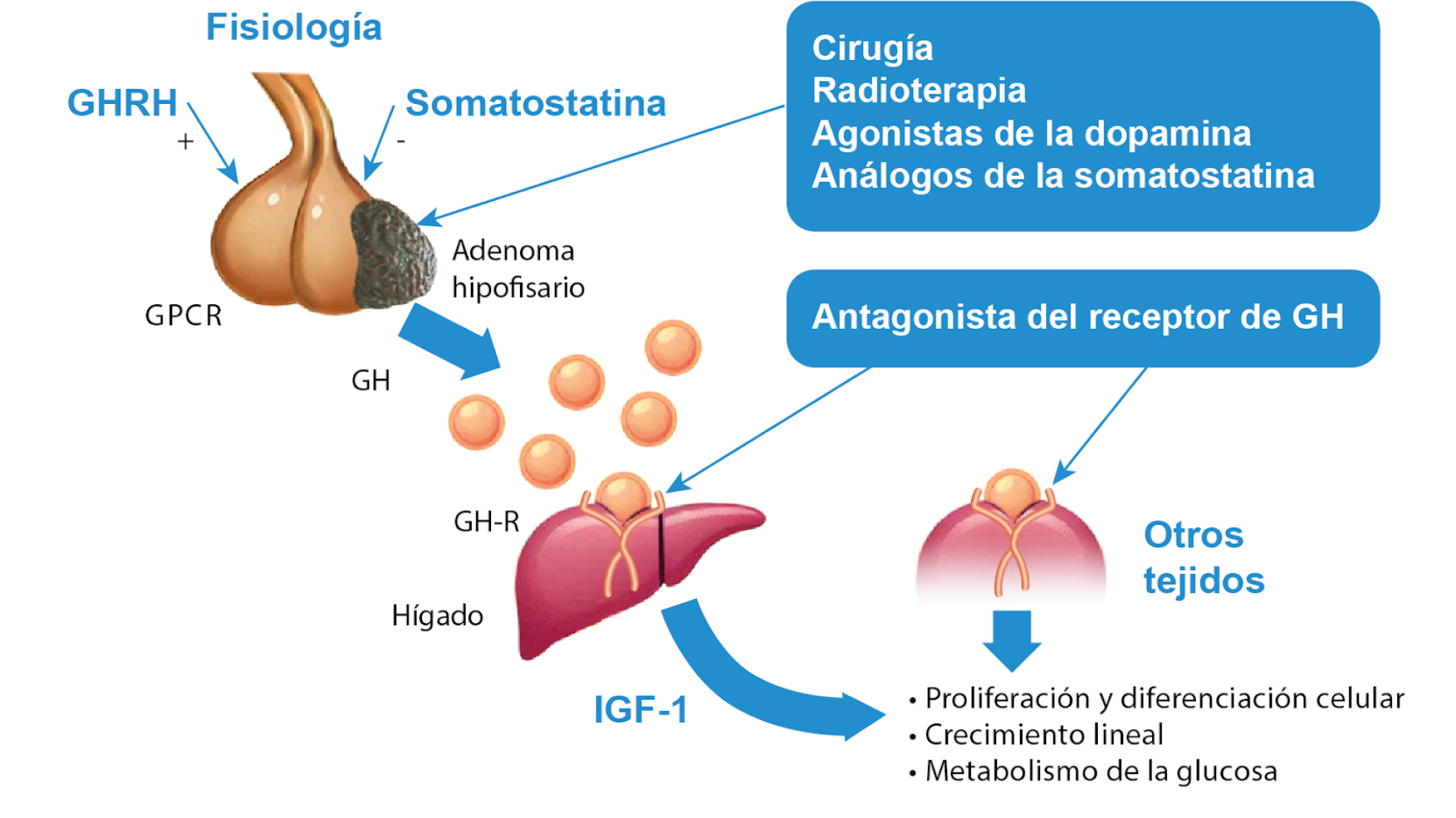 Figura 1: Los diferentes tratamientos para la acromegalia actúan en diversas áreas. La cirugía, la radioterapia, los análogos de la somatostatina y los agonistas de la dopamina trabajan directamente sobre el adenoma hipofisario, que es la causa principal de la secreción excesiva de GH. Por otro lado, los antagonistas de los receptores de la GH funcionan bloqueando el receptor de esta hormona en los tejidos periféricos, lo que impide que la GH ejerza sus efectos en esos tejidos. Diagrama del proceso fisiológico de la hormona de crecimiento (GH) y sus tratamientos. A la izquierda, se muestra la glándula hipófisis regulada por GHRH (que estimula) y somatostatina (que inhibe), produciendo GH. Una flecha conecta la hipófisis con el hígado, donde GH se une al receptor GH-R para estimular la producción de IGF-1. A la derecha, el IGF-1 actúa sobre otros tejidos, promoviendo la proliferación celular, crecimiento y metabolismo de la glucosa. En la parte superior derecha, se listan tratamientos como cirugía, radioterapia, agonistas de dopamina y análogos de somatostatina, junto con antagonistas del receptor de GH.